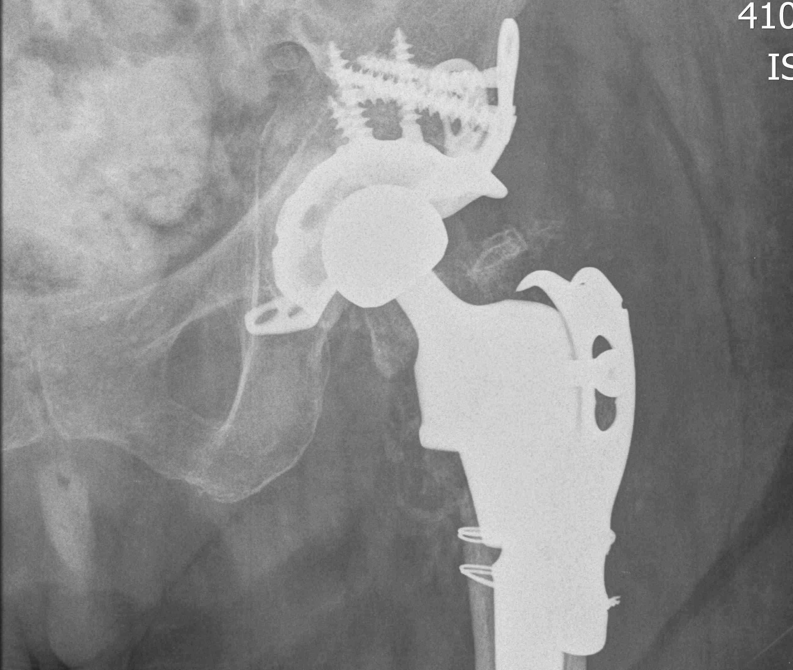 Bipolar Acetabular Destruction Revision 1